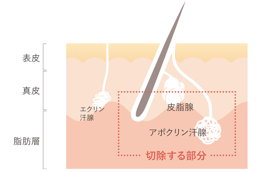 ワキガ（多汗症）の手術