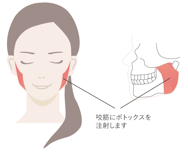 咬筋にボトックスを注射します