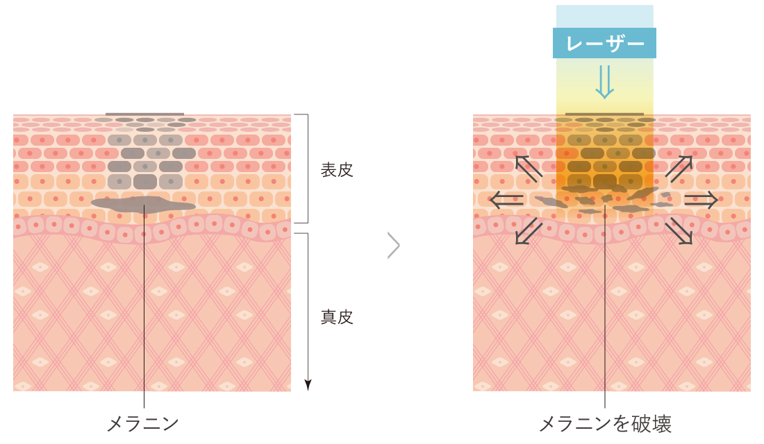 メラニンを破壊するレーザーのイメージ